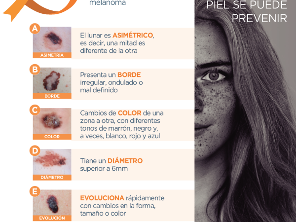 ¿Cómo te cuidas del Melanoma? mitos y verdades