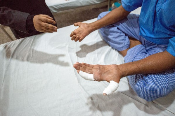 La Lepra sigue siendo una amenaza: conozca cómo prevenirla